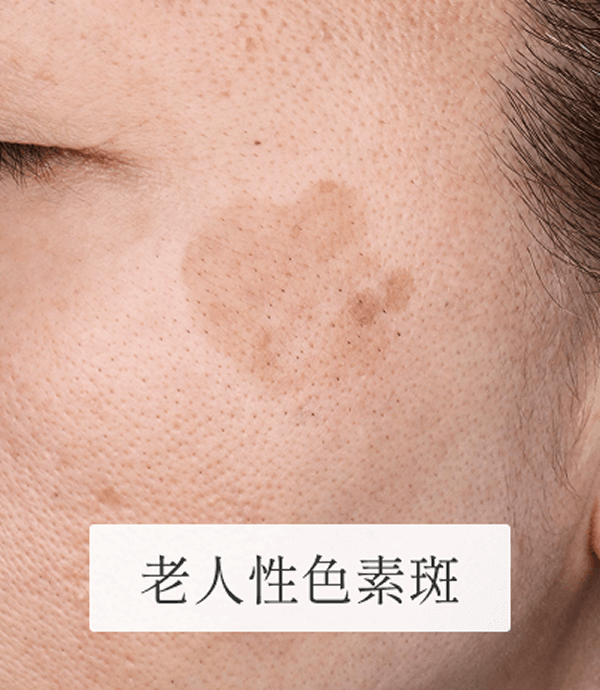 8_個別症例_老人性色素斑 1