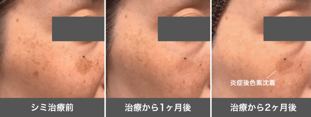シミ治療2ヶ月後_炎症後色素沈着_260205