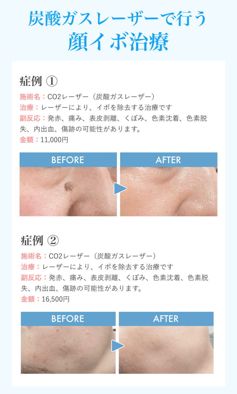 顔イボLP_①②_260218