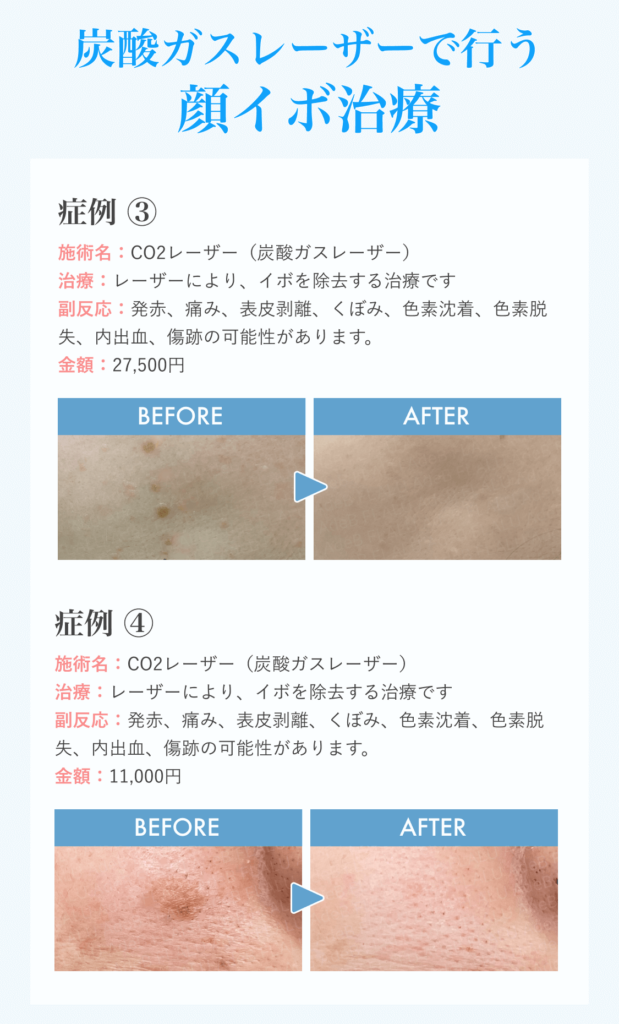 顔イボLP_③④_260218