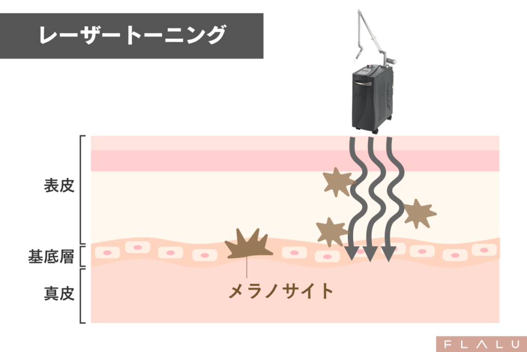 肝斑記事_レーザートーニングの説明画像