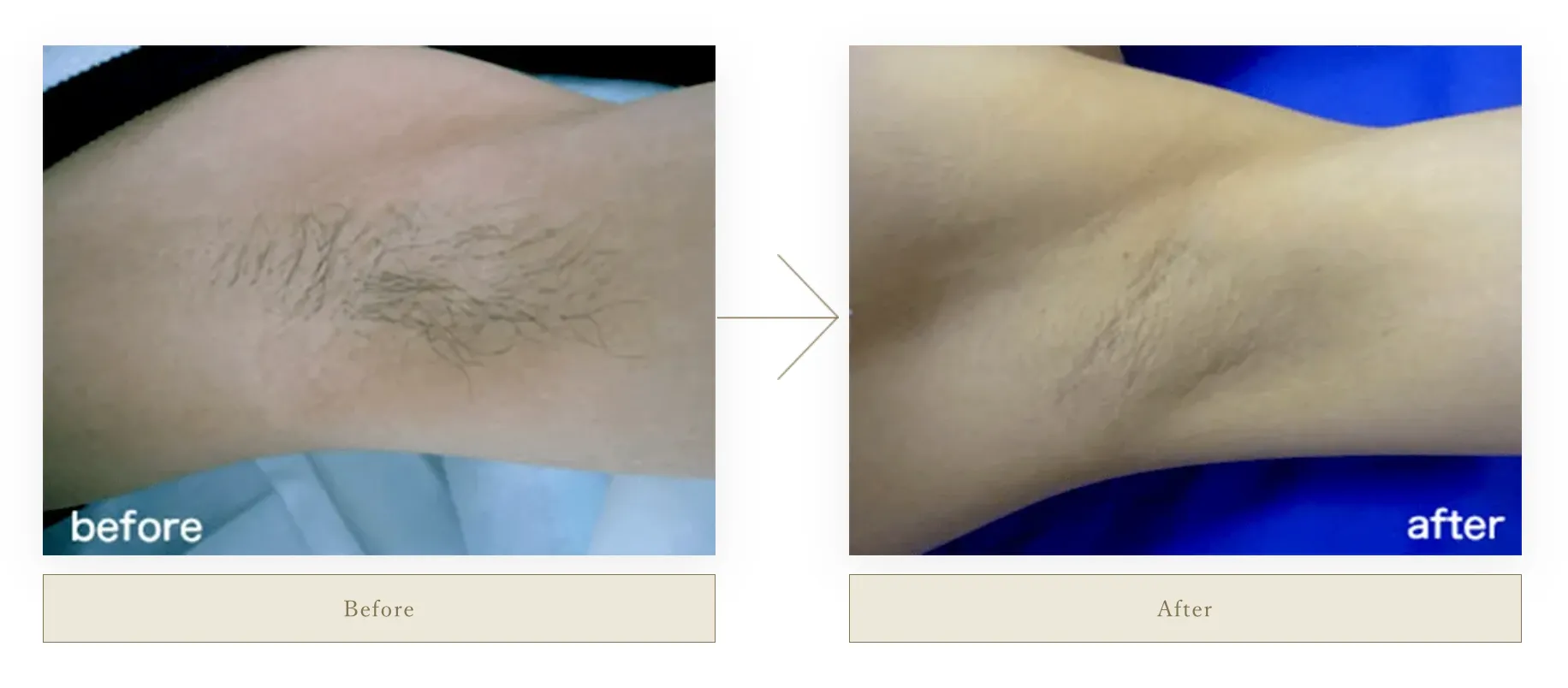 フェミークリニック　ワキ脱毛症例写真