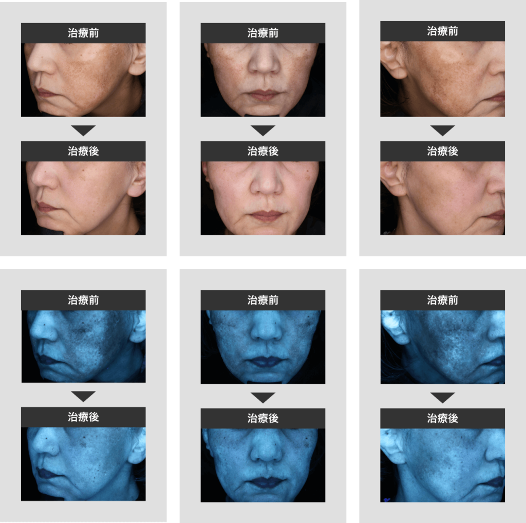 14_シミクリアセット_症例1