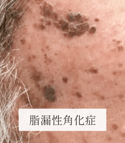 個別症例_脂漏性角化症_男性