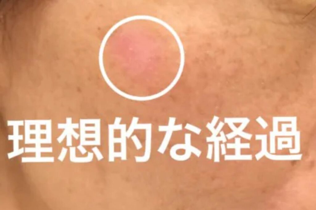 1〜2週間｜かさぶたが取れる時期