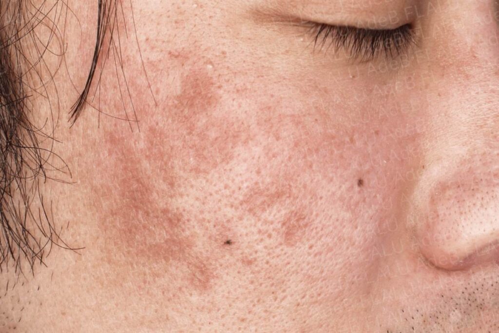 シミ取りレーザー後の色素沈着とシミレーザー治療のデメリット