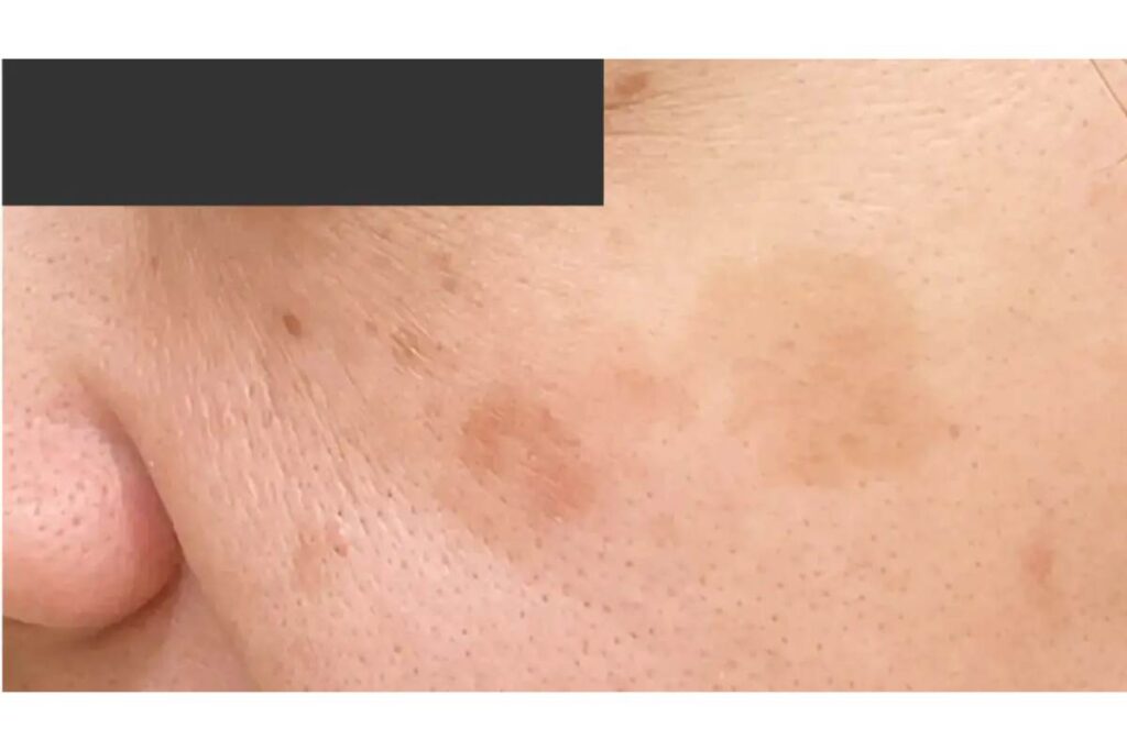 老人性色素斑（茶色いシミ）