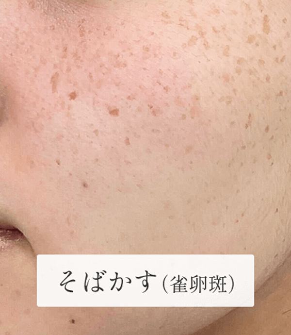 10_個別症例_そばかす 1