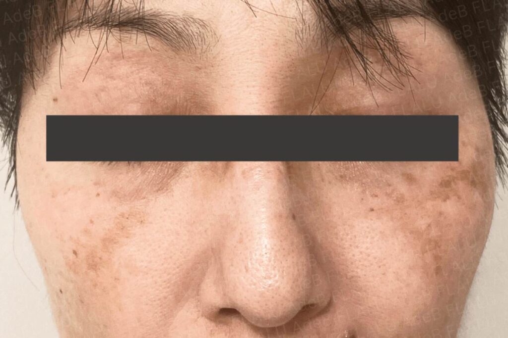 遺伝やホルモンの影響などがからむ肝斑