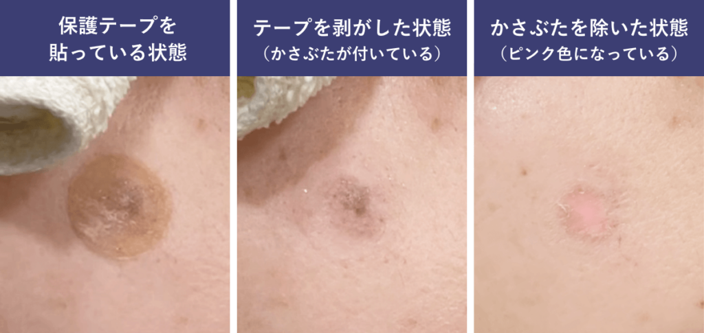 2_シミ治療_経過_2