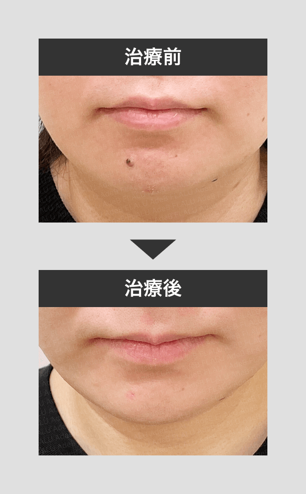 切除_ほくろ治療