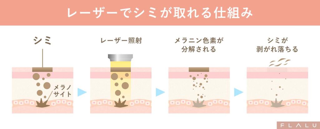 シミ取りレーザーの基本的な仕組み