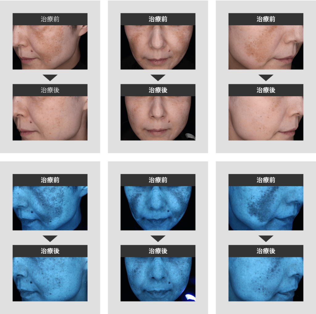 15_シミクリアセット_症例2