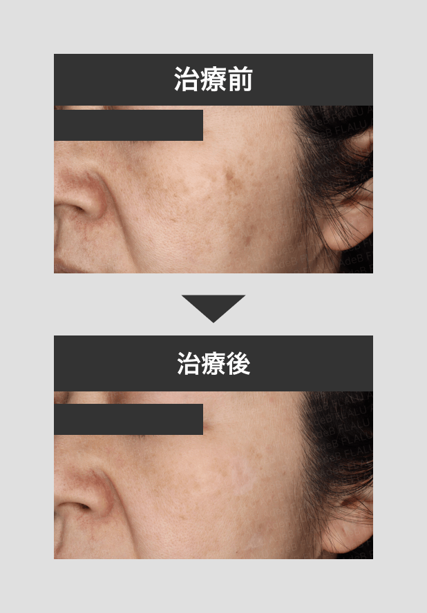 シミ5+美白内服+フラルスキン_2_mask_260413