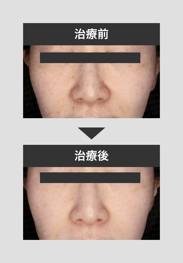 ピコトーニング_正面_左_260505