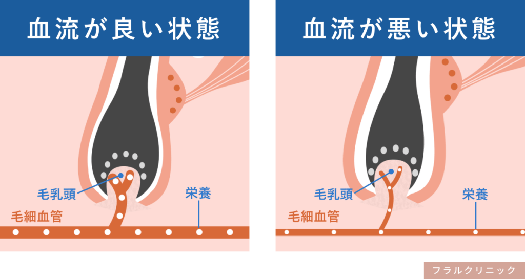 6_AGA_血流低下による髪への栄養不足