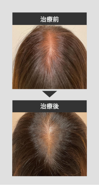 薄毛治療症例_2