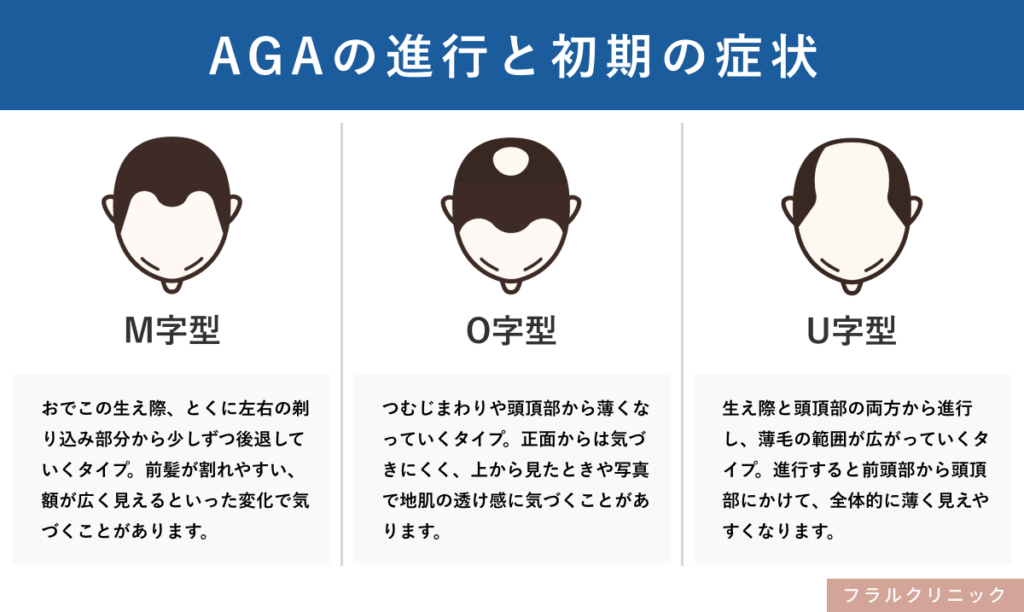 2_AGA_AGAの進行と初期の症状
