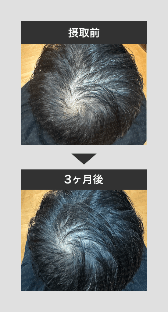 薄毛治療_黒髪生活3ヶ月
