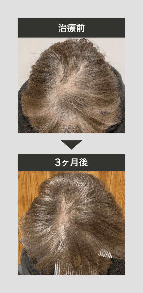 黒髪生活_3ヶ月_60代女性