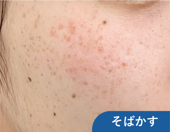 そばかす症例