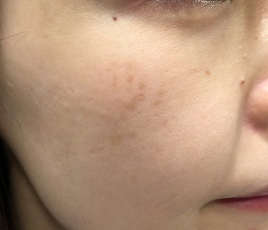 ADMの症状_頬部に淡い色素斑が限局して現れるタイプ
