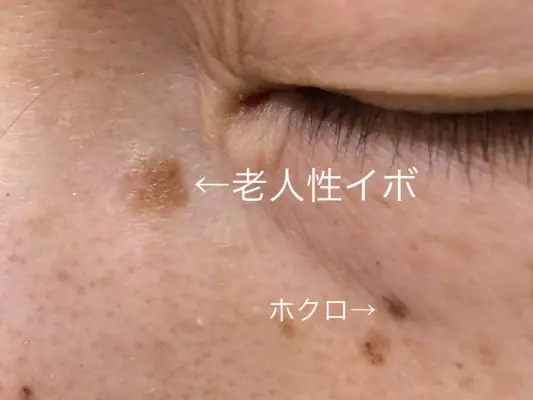 脂漏性角化症(老人性イボ)の写真