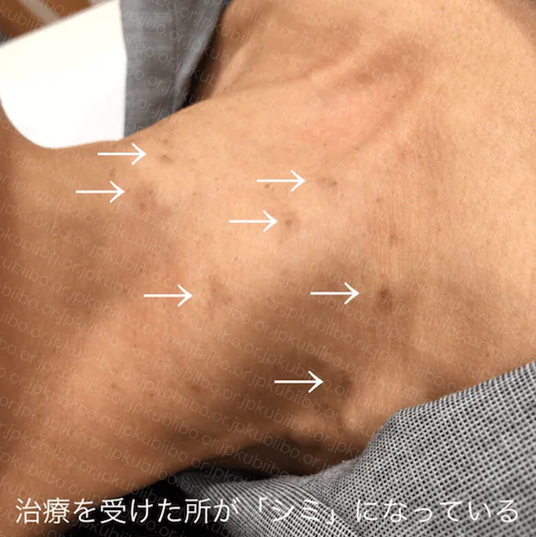 液体窒素によるイボ治療でシミができてしまった