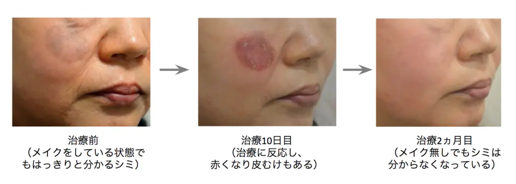 シミ治療の経過