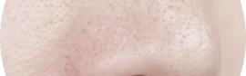 毛穴の開きの治し方