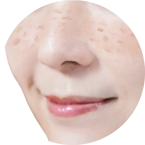 そばかす雀卵斑