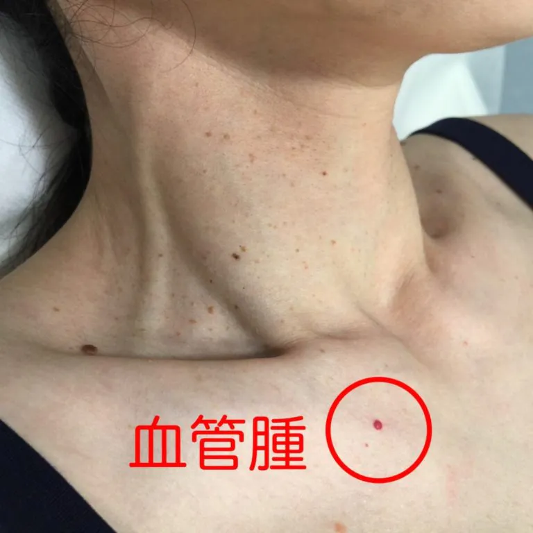 血管腫