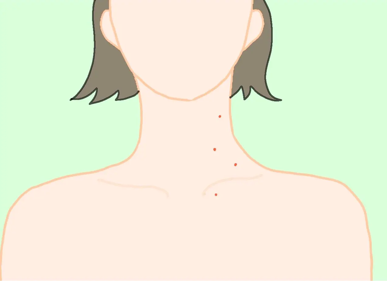 老人性血管腫(赤イボ) 老人性血管腫(赤イボ)