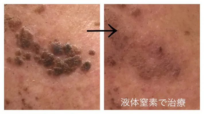 液体窒素での顔イボ治療