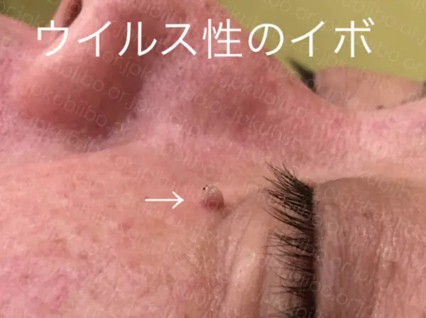 ウイルス性イボ