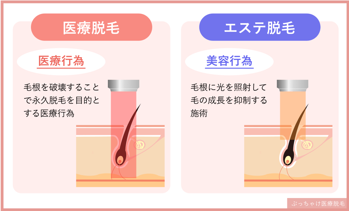 医療脱毛とエステ脱毛の違い