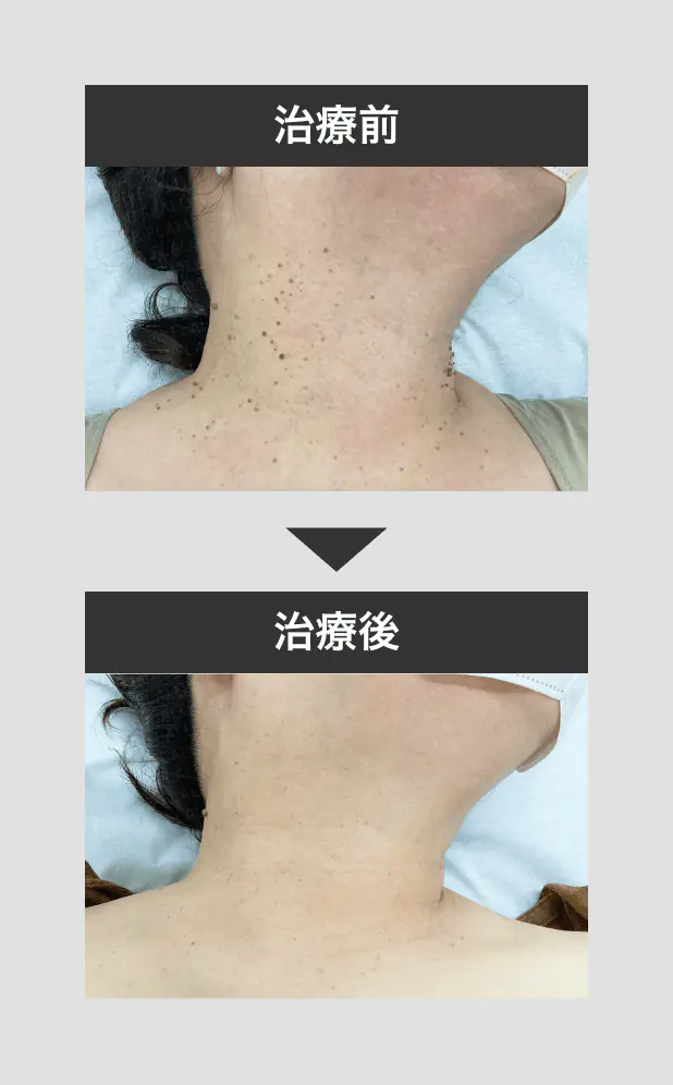 mikoメソッド1_mask_250424