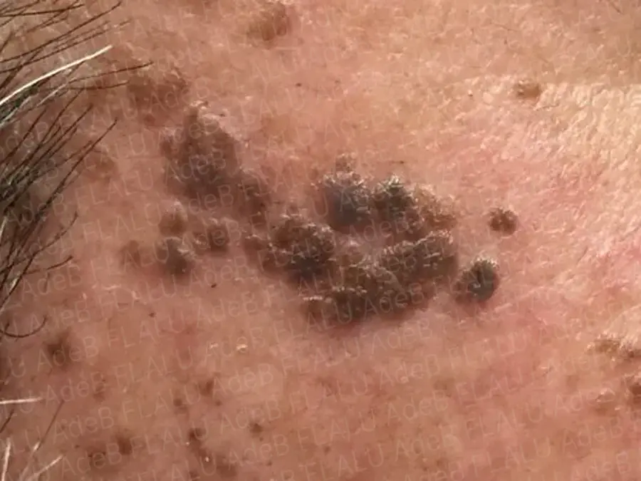 脂漏性角化症(老人性イボ)