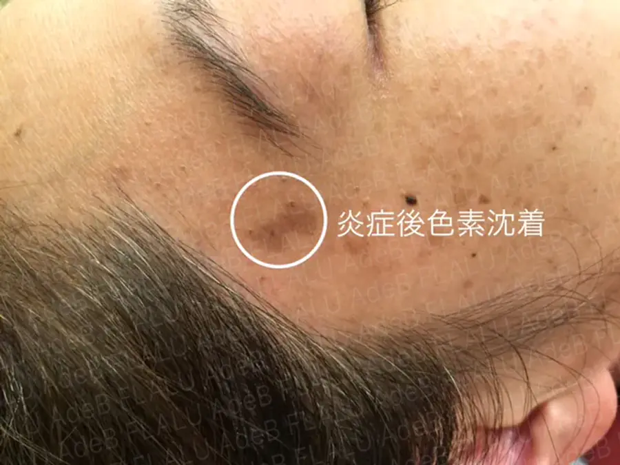 他院で液体窒素の治療後に炎症後色素沈着を起こした症例