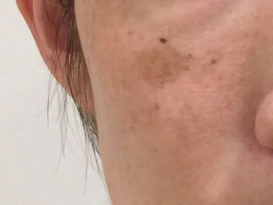 目の下にある老人性色素斑の症例写真