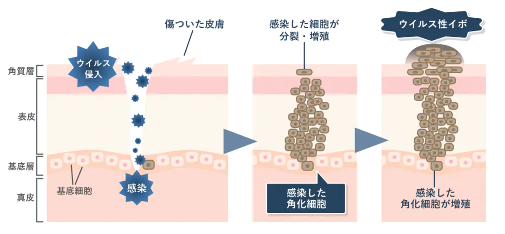 尋常性疣贅ができるまでの仕組みの画像