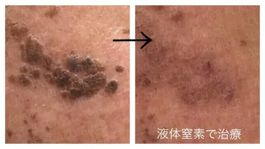 脂漏性角化症_8