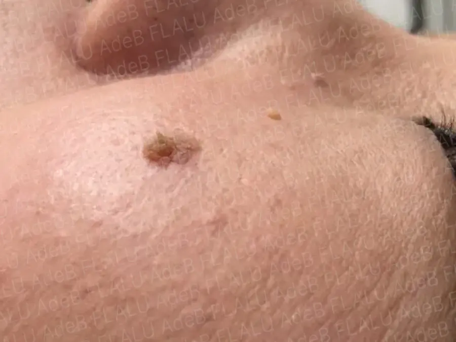 脂漏性角化症_6