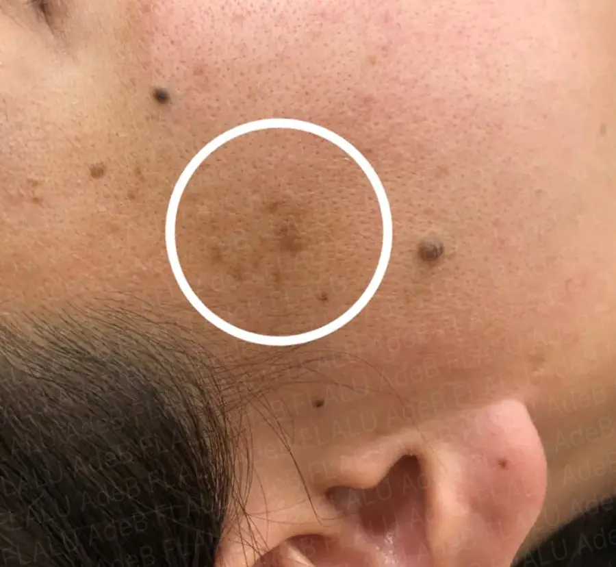 女性のこめかみにある老人性イボ(脂漏性角化症)の症例写真