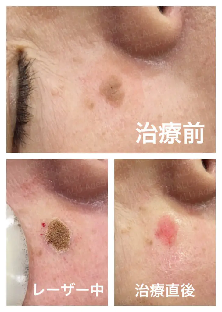 脂漏性角化症_10