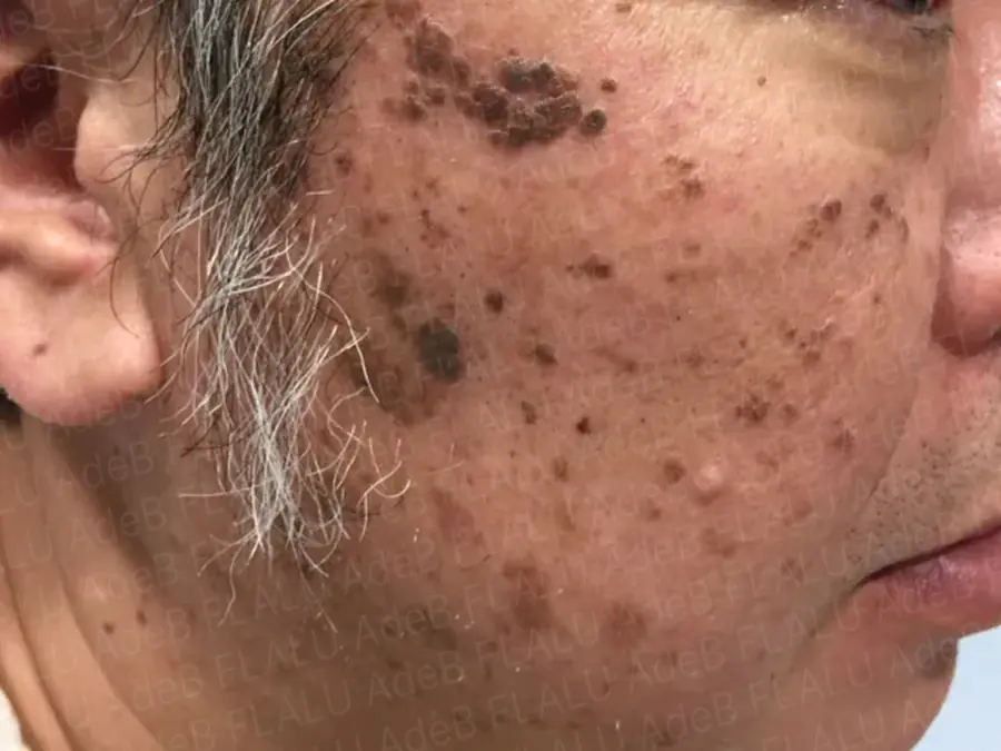 男性の顔にある茶色い老人性イボ(脂漏性角化症)の症例写真