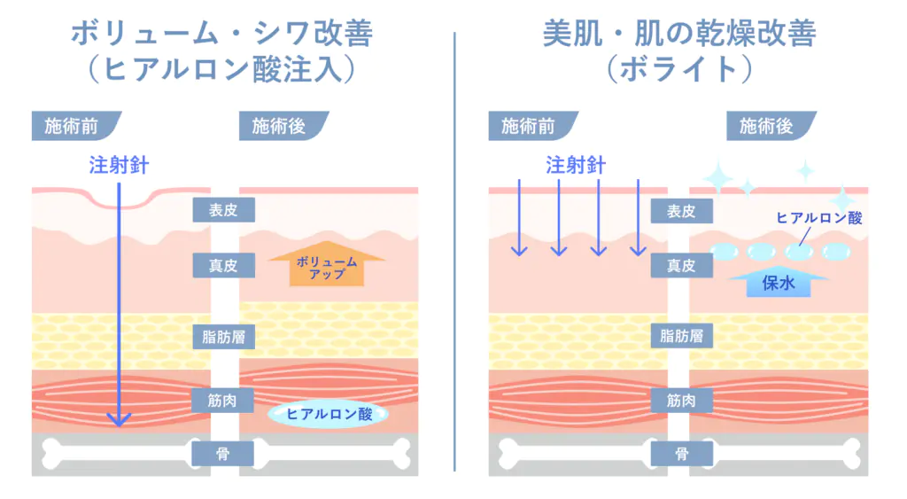 ボライト_ヒアルロン酸注入との違い_1_250614