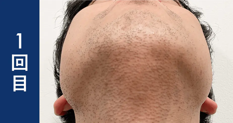 ヒゲ脱毛1回目のレビュー・ビフォーアフター画像