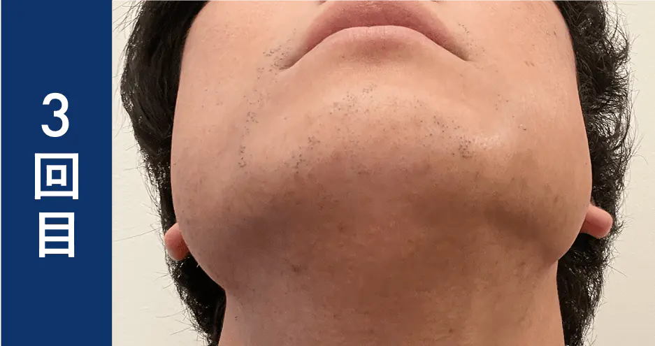 ヒゲ脱毛3回目のレビュー・ビフォーアフター画像