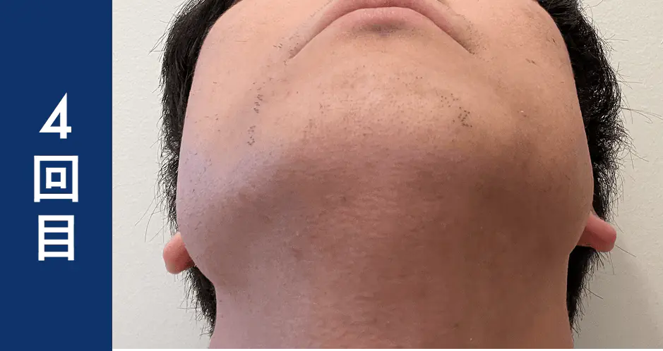 ヒゲ脱毛4回目のレビュー・ビフォーアフター画像